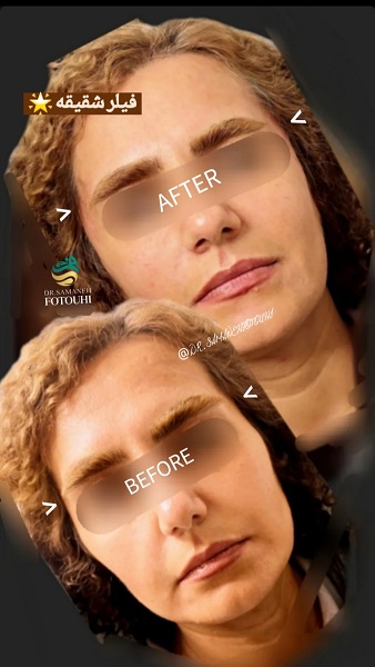 نمونه فیلر شقیقه دکتر سمانه فتوحی