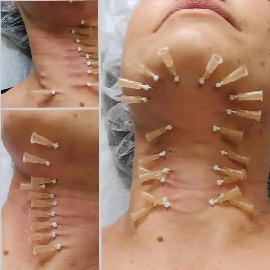 امبدینگ یا لاغری با نخ