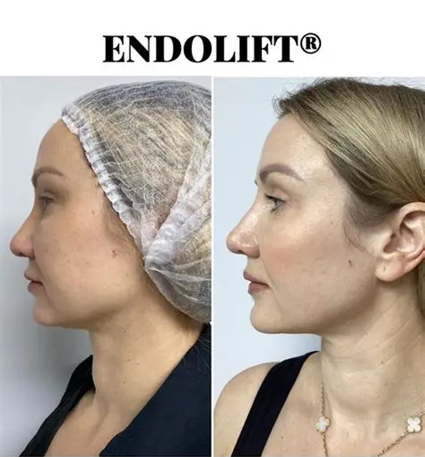 اندولیفت یوفوتون