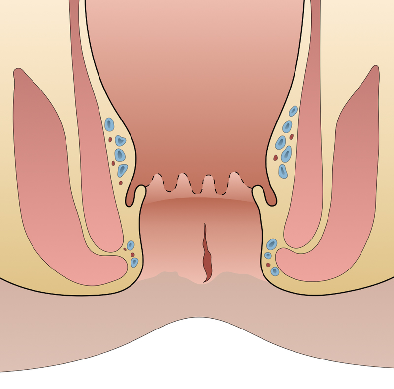 عوارض شقاق مقعد (فیشر آنال)