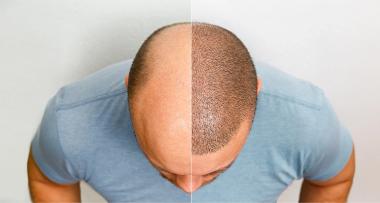 پی آر پی (PRP) بعد از کاشت مو چه فوایدی دارد؟