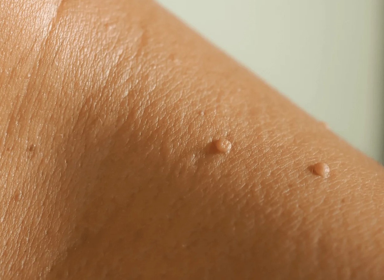 ویژگی های خال گوشتی