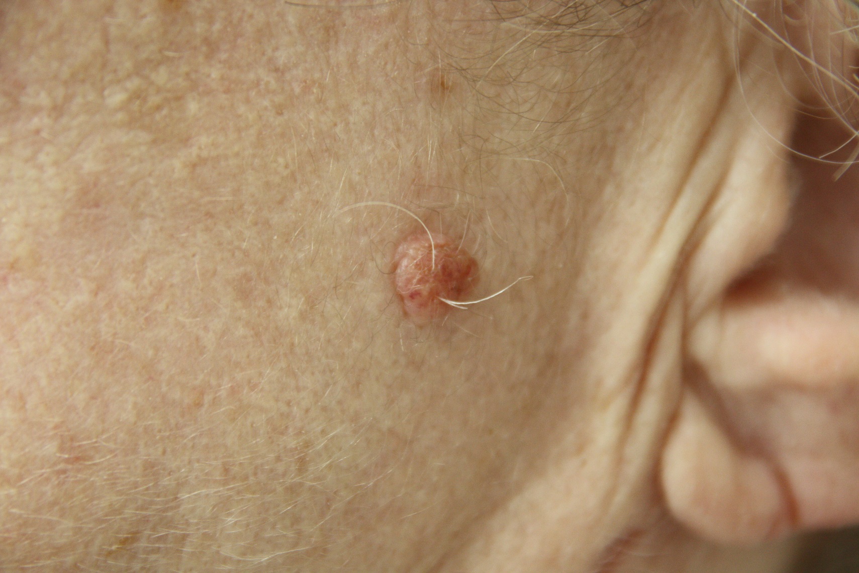 خال گوشتی چیست؟