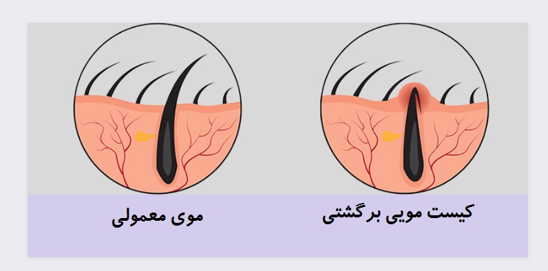 کیست مویی چگونه به وجود می‌آید؟