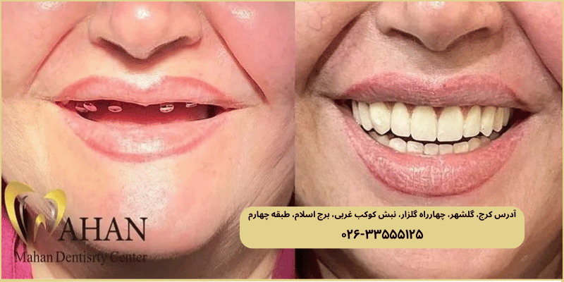 برای ایمپلنت و جراحی لثه در کرج به کجا مراجعه کنیم؟