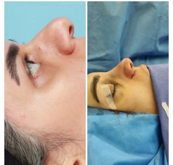نمونه جراحی بینی گوشتی قبل و بعد - دکتر علی اصغر شیرازی