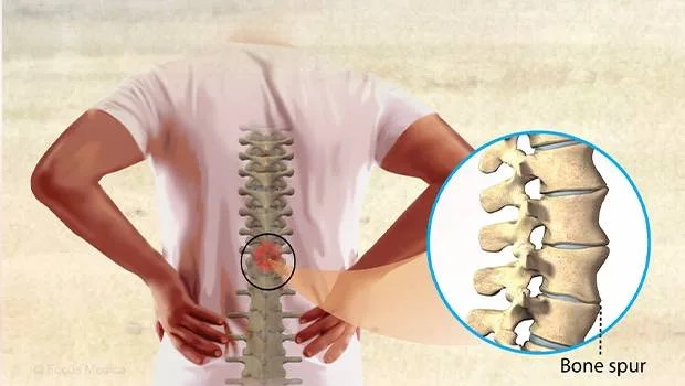 خارهای استخوانی ناشی از آرتروز
