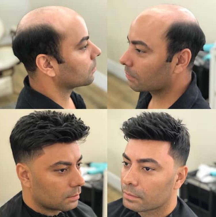 کاشت مو با لیزر یا کاشت مو با روش سنتی؛ کدام یک بهتر است؟