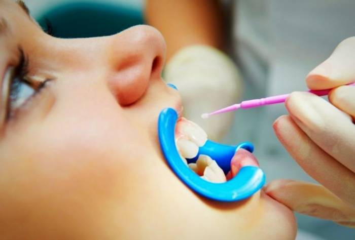 فلورایدتراپی و فواید آن