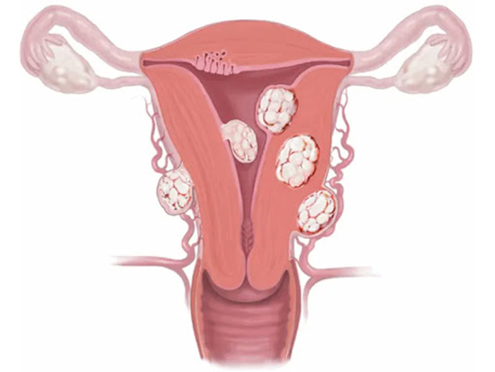 بهترین روش درمان فیبروم رحم چیست؟
