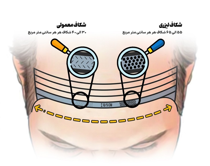 مزایای کاشت مو با لیزر