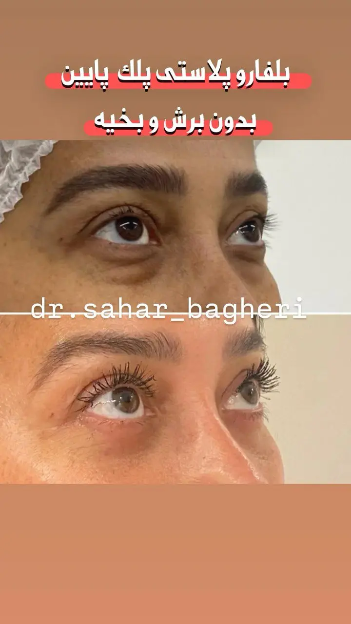 بلفاروپلاستی3
