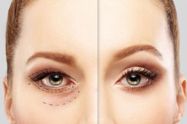 لیفت ابرو با اندوتاین چگونه است؟
