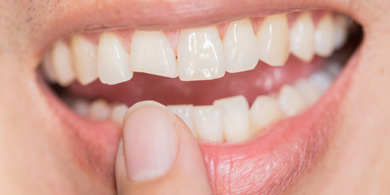 هزینه ترمیم کامپوزیت دندان چقدر است؟