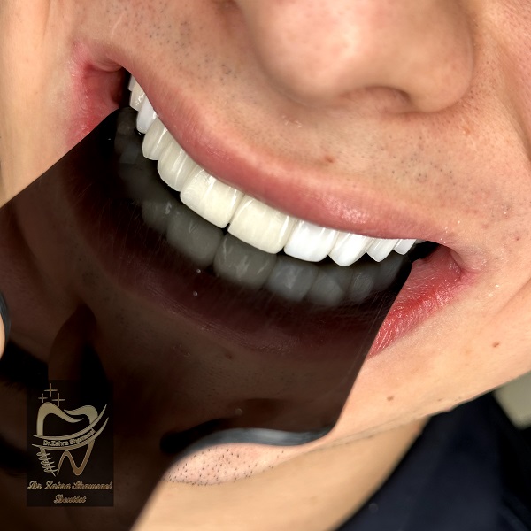 ایمپلنت لیزری دندان چیست؟ + مزایا و هزینه