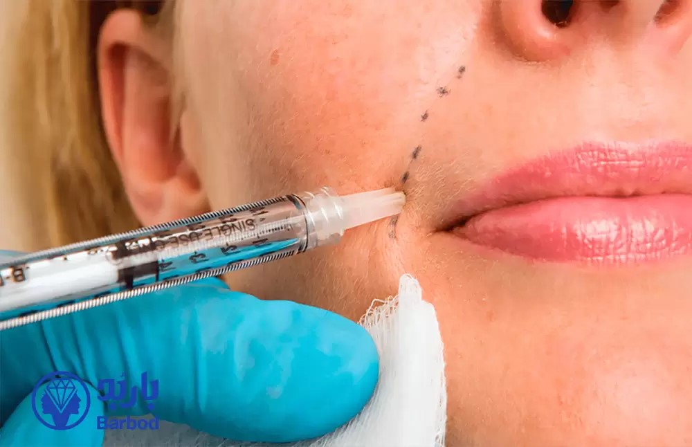 فیلر خط خنده چیست؟