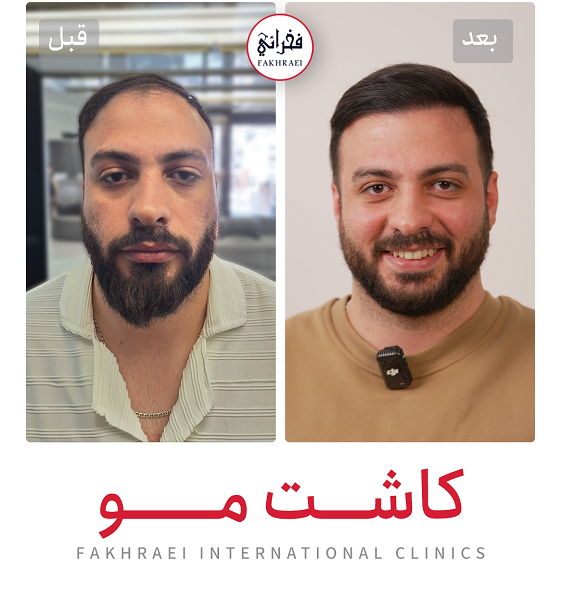 نمونه کاشت مو - کلینیک فخرایی