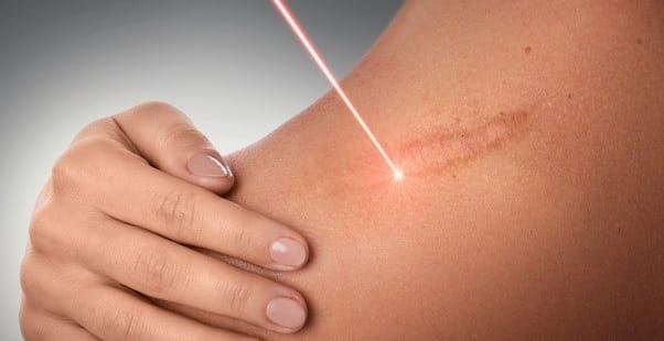 نقش سلول های بنیادی در زخم ها