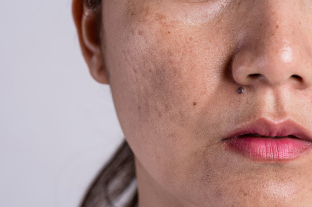 woman_with_problematic_skin_acne_scars_problem_skincare_concept