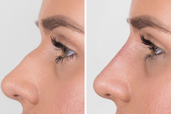 Nasal-filler-injection-2