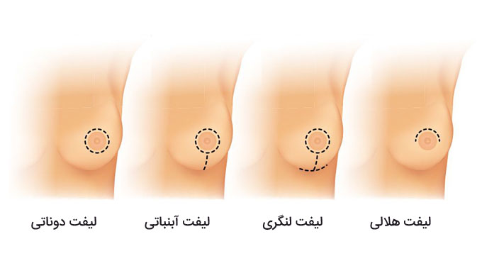 انواع جراحی لیفت سینه: کدام روش برای شما مناسب‌تر است؟