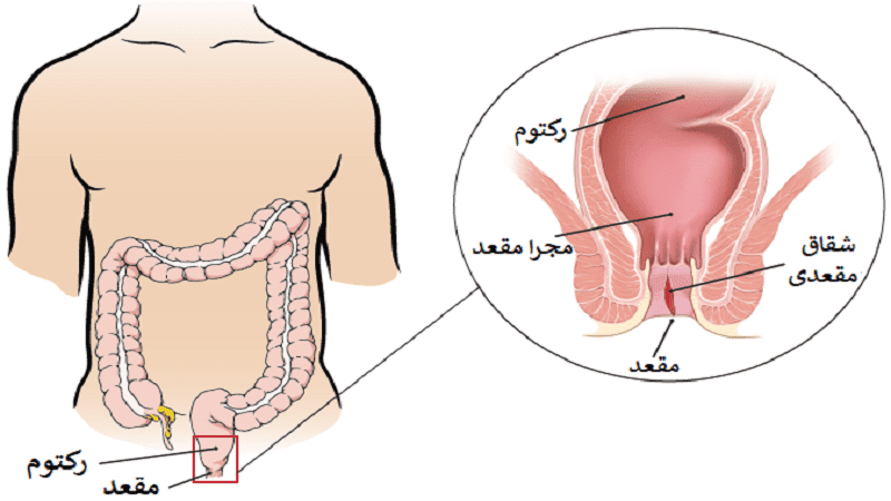 علائم بیماری شقاق چیست؟