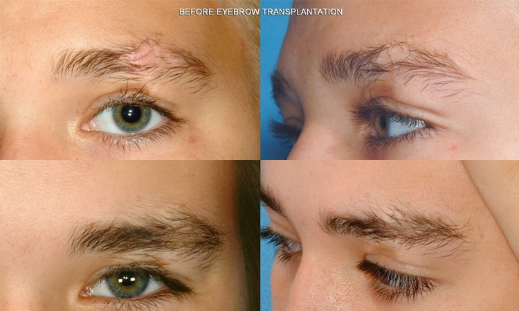 مزایای جدیدترین روش های کاشت ابرو