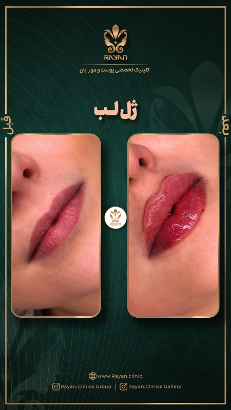 نمونه تزریق ژل لب روسی در کلینیک رایان سلامت
