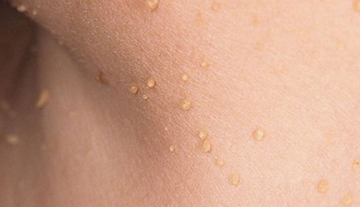 خال-گوشتی-min