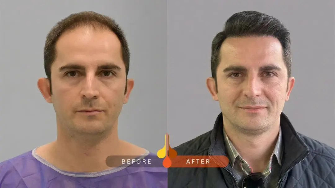 hair-transplant-before-after-7