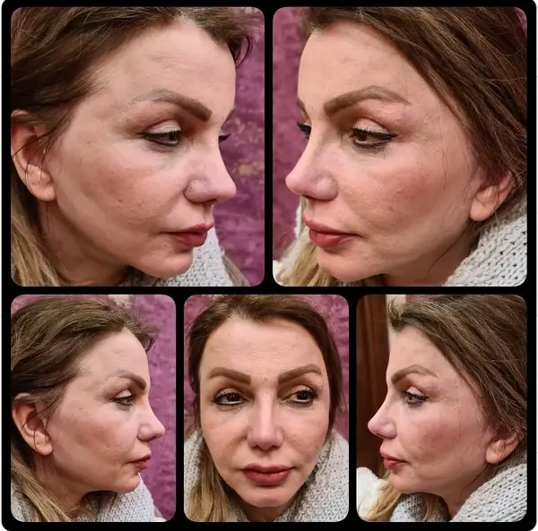 نمونه لیفت صورت دکتر سعید رجبیان