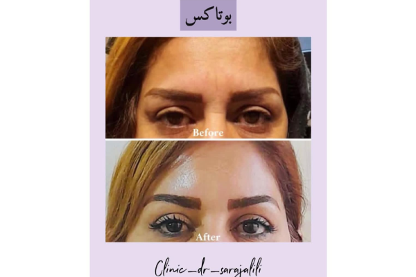 نمونه بوتاکس دکتر سارا جلیلی