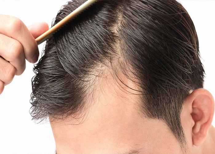 دلایل ریزش مو راهکارهای درمانی