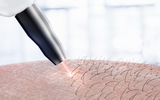 laser-removal