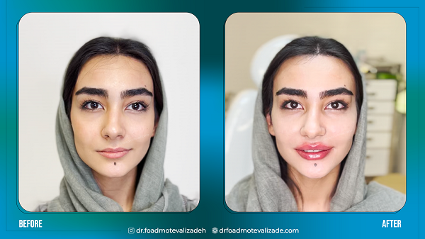 تزریق به صورت دکتر فواد متولی زاده