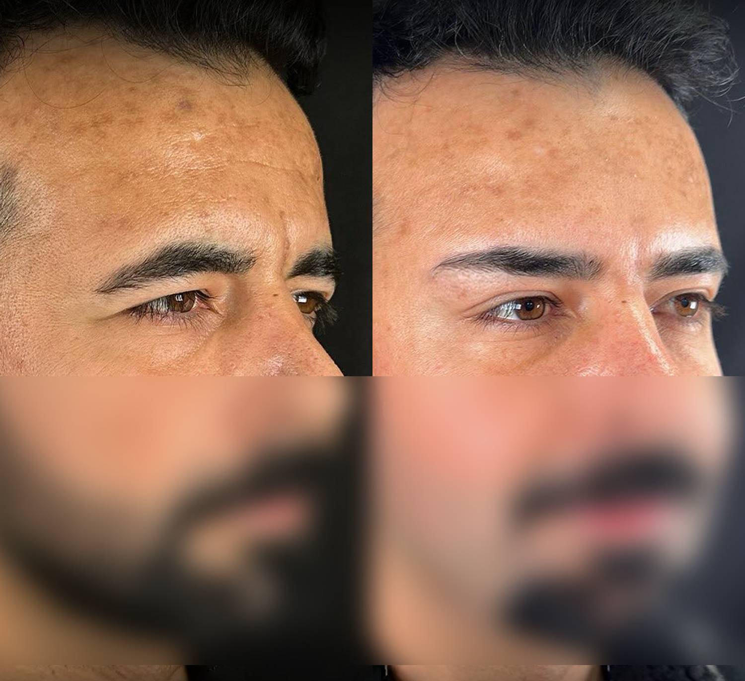 نمونه لیفت شقیقه-ل03
