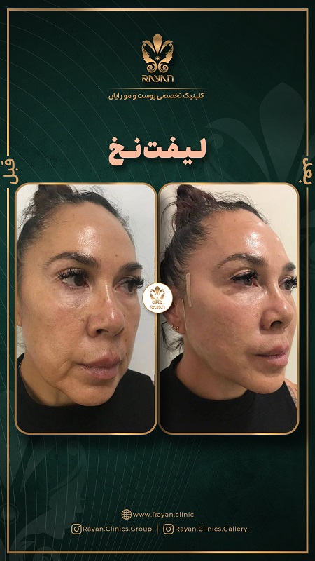 لیفت صورت با نخ - کلینیک رایان سلامت
