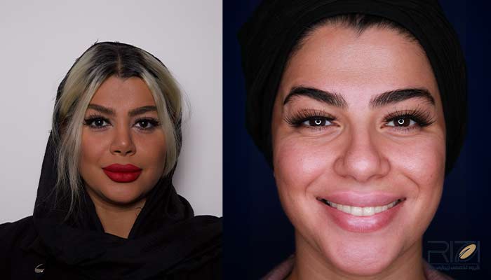 Sample-before-and-after-nose-surgery-5