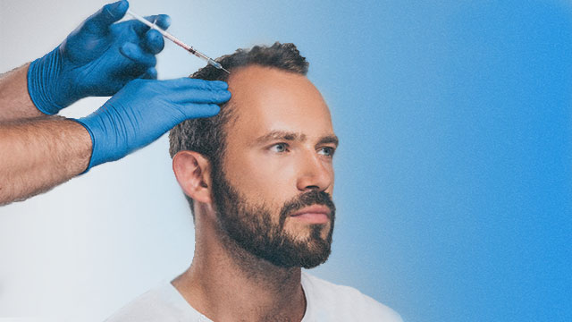 فیلر مو آقایان