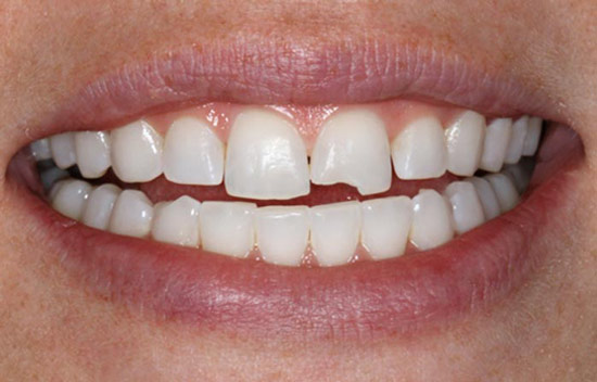 هزینه ترمیم کامپوزیت دندان چقدر است؟