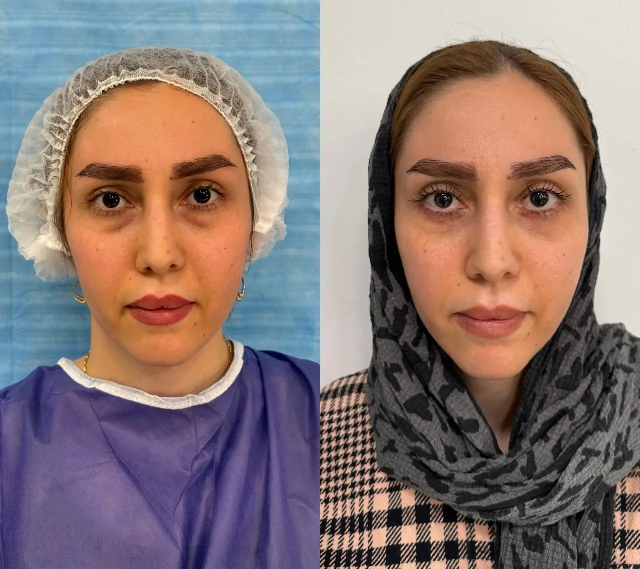 بلفاروپلاستی2