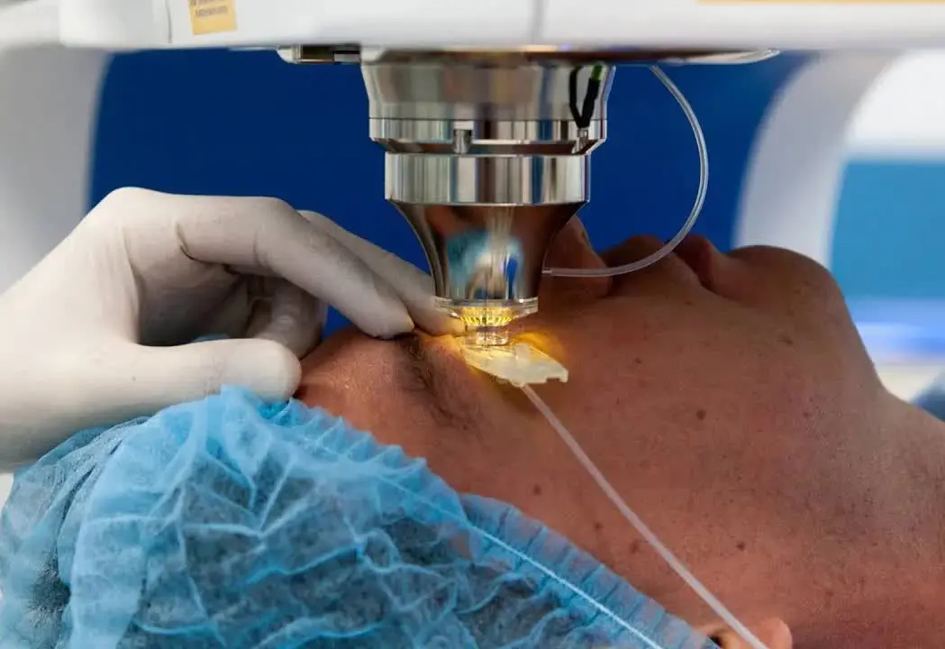 Femto-Lasik-