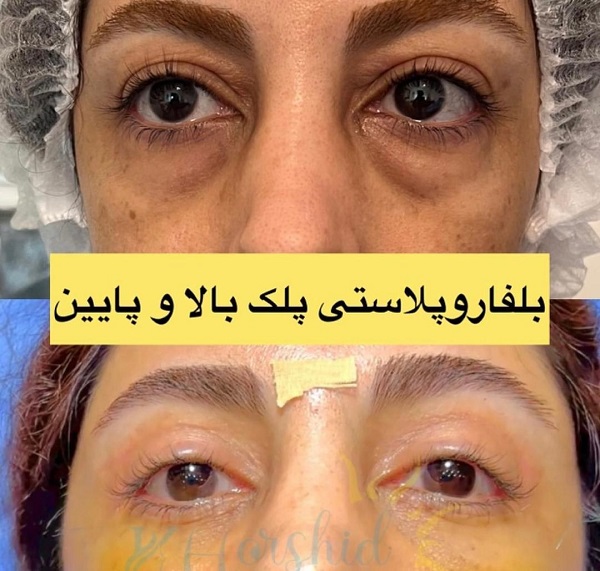 نمونه های جراحی پلک در سپید پلک