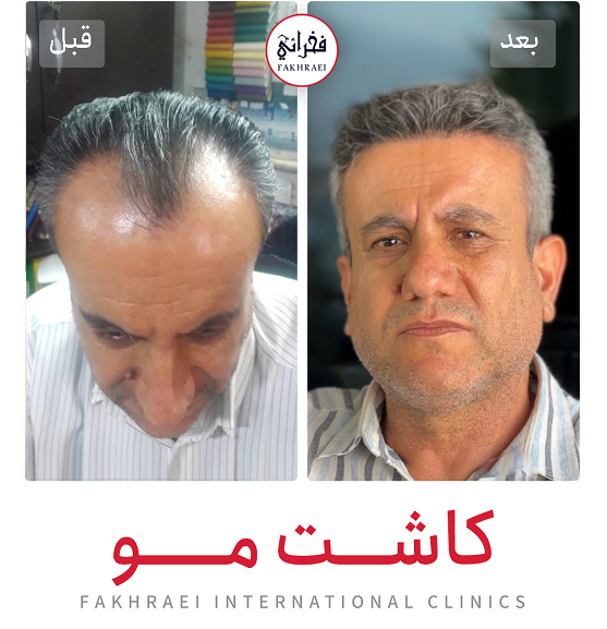 نمونه کاشت مو - کلینیک فخرایی