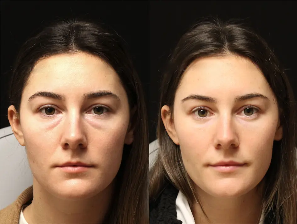 بلفاروپلاستی چه مزایایی دارد؟