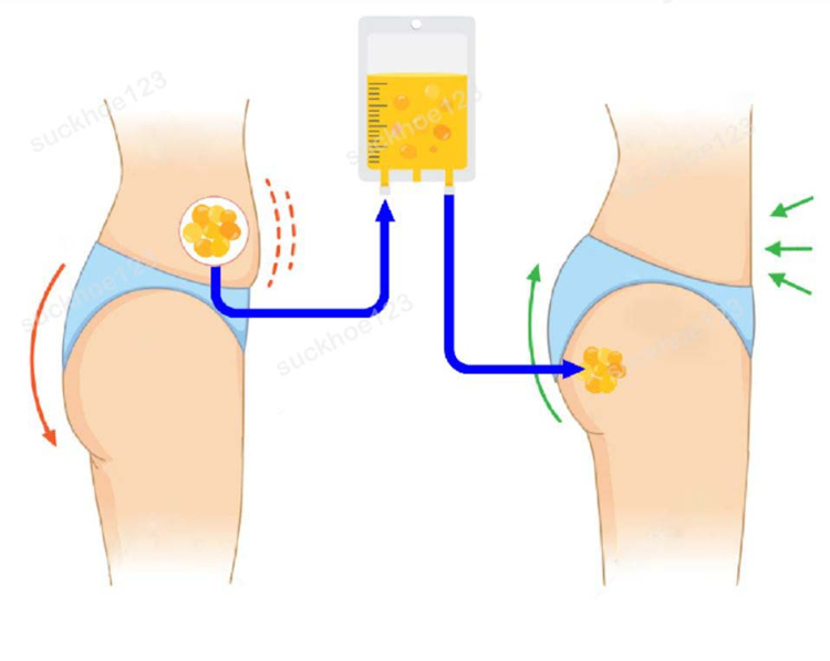 مراحل تزریق چربی به باسن