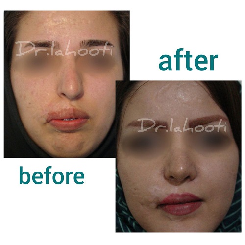 نمونه َجراحی ترمیم صورت بعد از سوختگی - دکتر مجید لاهوتی