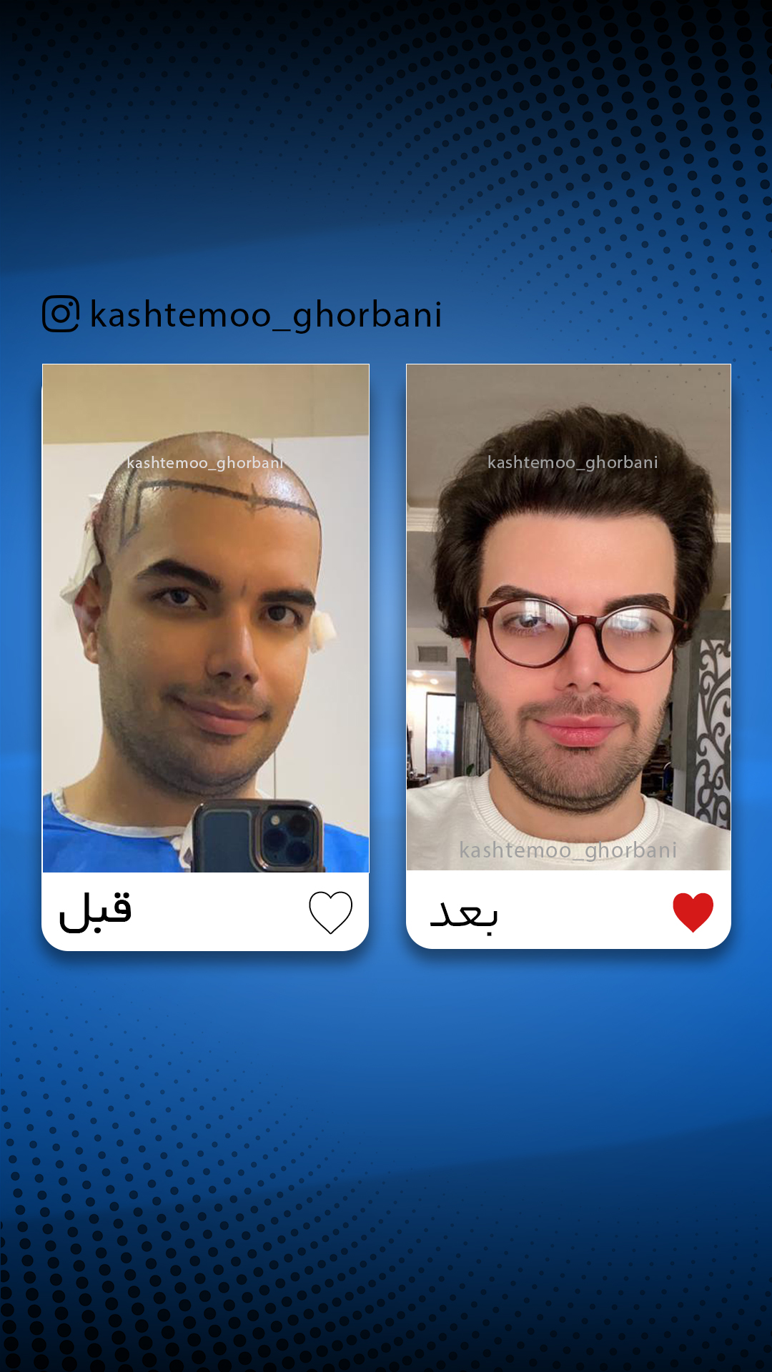 قبل و بعد آبی 3
