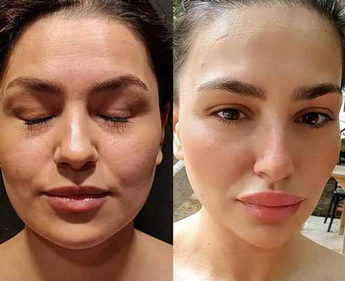 1661843015-buccal-fat-surgery-whcl1