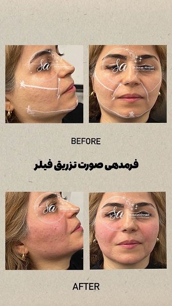 نمونه تزریق چربی - دکتر سوسن احمدی